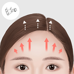 Placing and securing an endotine in the deep fascia or skull to lift the drooping forehead