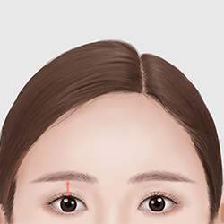 Improving wrinkles between the brows, around the eyes, and on the eyelids to achieve a youthful appearance