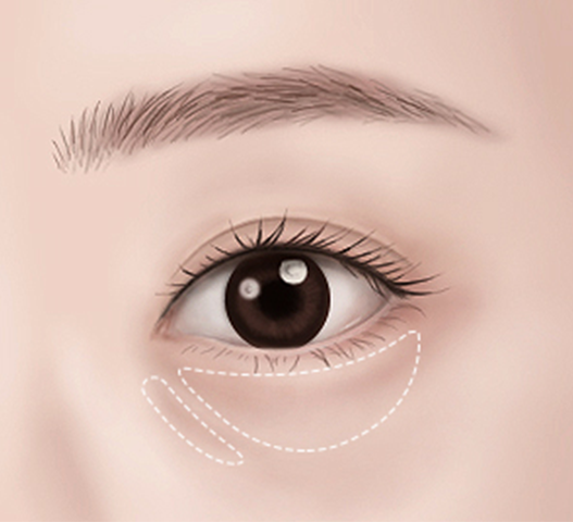 Transconjunctival Fat Repositioning