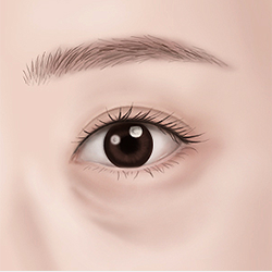 Marking a surgical design based on individual bone, muscle, and skin structure around the eyes