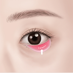 Performing a micro-incision in the inner conjunctiva during lower eyelid surgery