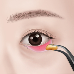 Removing sagging fat and repositioning it above the periosteum and below the skin before conjunctival fixation