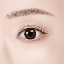 Finalizing the procedure by suturing inside the conjunctiva