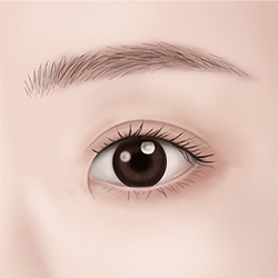 Assessing hooded eyes with Mongolian folds during preoperative evaluation