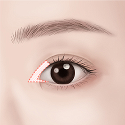 Marking and designing the incision site based on facial and eye proportions