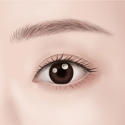 Achieving wide and bright-looking eyes after inner corner surgery