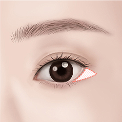 Marking the crease and incision site for lateral canthoplasty
