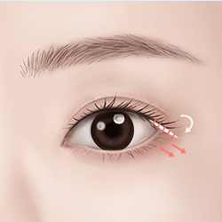 Cutting the inner conjunctiva, repositioning it from the back of the eye, and fixing it securely to the periosteum