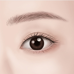 Precisely suturing the incisions to achieve a fresh-looking eye appearance with minimal visible scarring