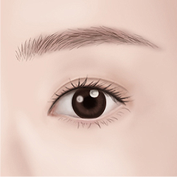 Assessing blocked eye corners during preoperative evaluation