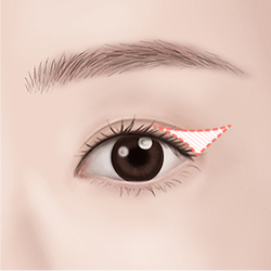 Designing the eye opening and angle according to the desired eye shape and facial ratio