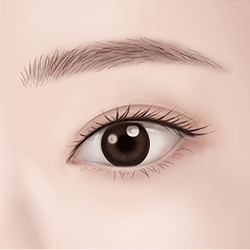 Precisely suturing the incisions to achieve a fresh-looking eye appearance with minimal visible scarring