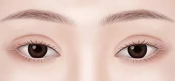 Evaluating residual fat or an overly thick double eyelid crease during postoperative assessment