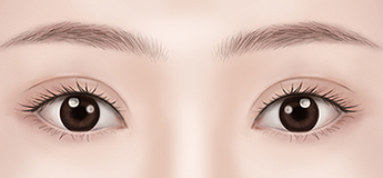 Assessing a double eyelid crease positioned too high during postoperative evaluation