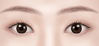 Assessing an overly thin double eyelid crease during postoperative evaluation