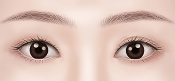 Uneven double eyelids