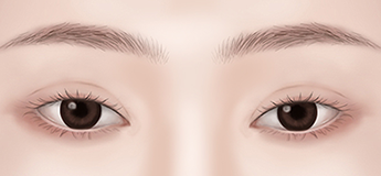 Double eyelid loosening after surgery (recurrence)