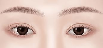 Eyes that look small after surgery because the ptosis was not corrected