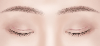 Assessing visible scarring following eyelid surgery during postoperative evaluation