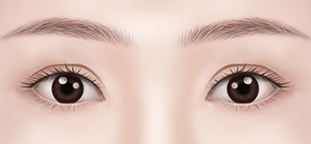 Assessing inability to close the eyes due to overcorrection after eyelid surgery