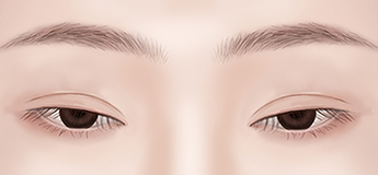 Assessing aesthetic dissatisfaction with eyelid surgery results during postoperative consultation