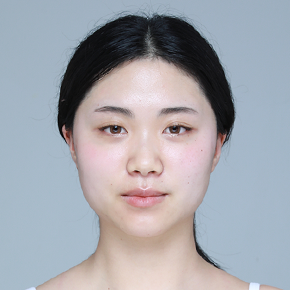 Revision Eye Surgery before