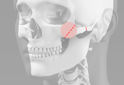 Non-fixed surgical method