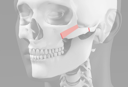 L-shaped osteotomy cheekbone reduction