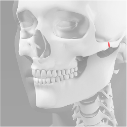 Performing osteotomy on the lateral cheekbone area during cheekbone reduction surgery