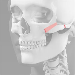 Removing the inner side of the frontal cheekbones in a trapezoidal shape during cheekbone reduction surgery