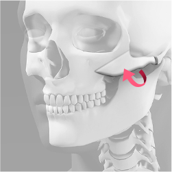 Repositioning the remaining cheekbones inward, upward, and backward to align the excised bone edges during cheekbone reduction surgery