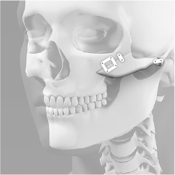 Fixing the front and back cheekbone segments securely with titanium screws and plates