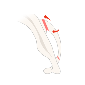Braun’s cheekbone reduction before