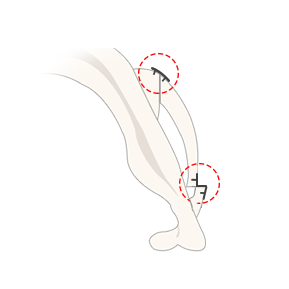 Braun’s cheekbone reduction after