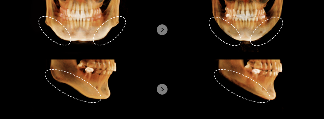 Before vs. After Mouth Corner Square Jaw Surgery