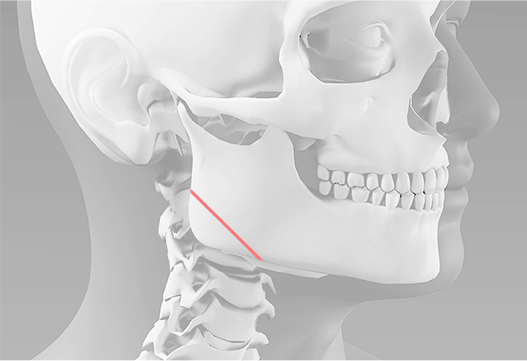Resecting a portion of the square jaw below the ear during jaw contouring surgery