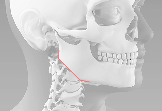 Performing lateral cortical bone shaving on the square jaw area below the ears