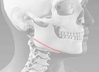 Resecting the square jaw toward the side of the chin without creating a secondary angle