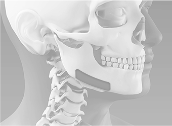 Performing lateral cortical bone shaving along the entire jaw bone during jaw contouring surgery