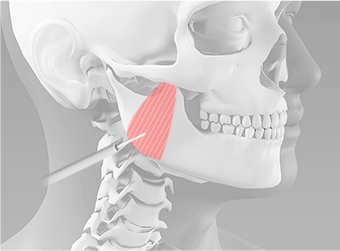 Reducing the square jaw masseter muscles using high-frequency nerve block during jaw contouring procedure