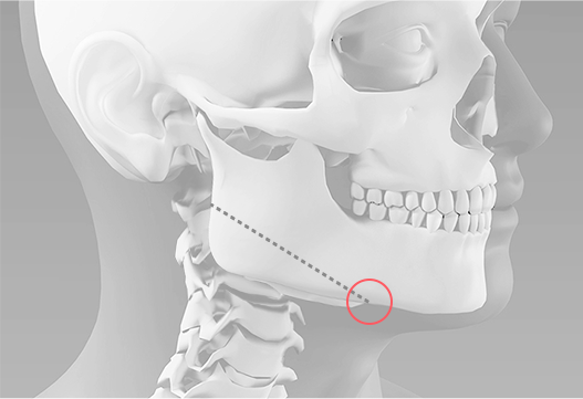The general square jaw surgery method