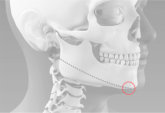 Braun’s square jaw surgery method