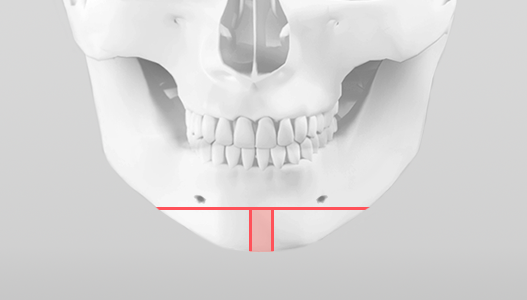 Traditional Ineffective Methods  |  T-shaped Osteotomy