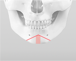 Excising the chin bone through an inverted V-shaped osteotomy during chin surgery