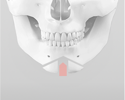 Removing the middle chin bone segment to precisely control chin length based on the bone cut shape