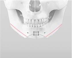 Gathering and fixing excised chin bone segments with a titanium plate and screws to adjust chin position
