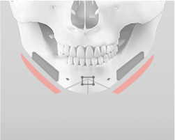 Performing square jaw resection combined with lateral cortical bone shaving during jaw contouring surgery