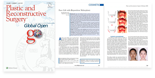 Publishing a research thesis on 3D rotation-lifting cheekbone reduction surgery in The Journal of Craniofacial Surgery