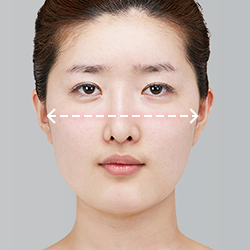 Evaluating lack of visible effect following cheekbone reduction surgery during postoperative assessment