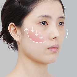 Assessing cheekbone drooping, non-union, or dent formation after cheekbone reduction surgery